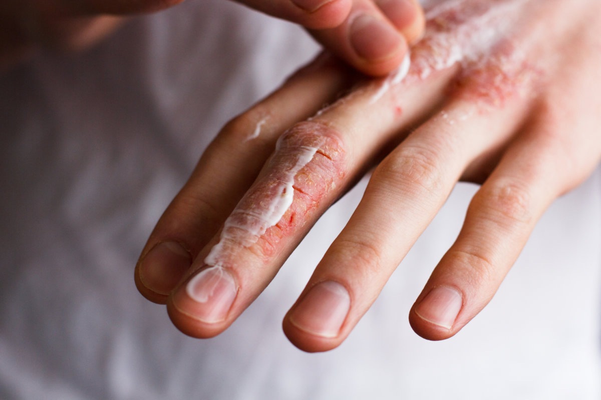 What is Ichthyosis?