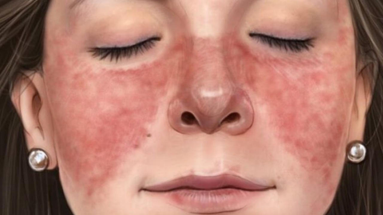 What are the contraceptive options for women with systemic lupus erythematosus?